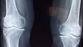 무릎에 발생한 골관절염